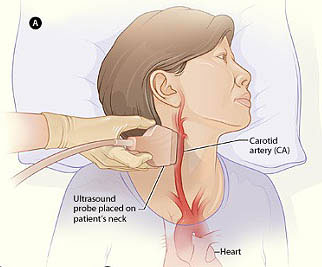 carotid-ultrasound.jpg